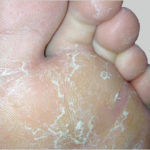 Foot People Lindsay Chiropody podiatry athletes foot