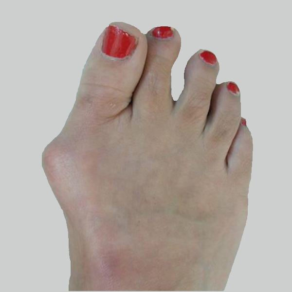 Foot People Lindsay Chiropody podiatry bunions treatment