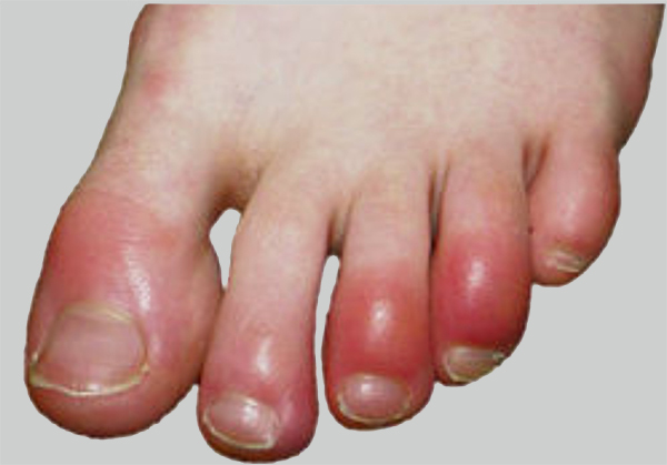 Foot People Lindsay Chiropody podiatry chilblains treatment