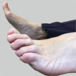 Foot People Lindsay Chiropody podiatry hammer toes