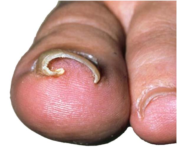 Foot People Lindsay Chiropody podiatry involuted toenail