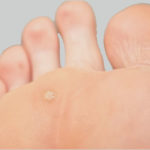 foot people lindsay chiropody podiatry verruca treatment