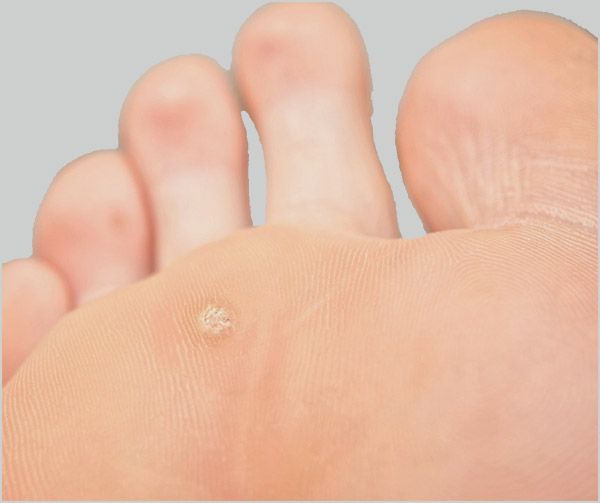 What causes papilloma on foot, Papilloma on foot causes