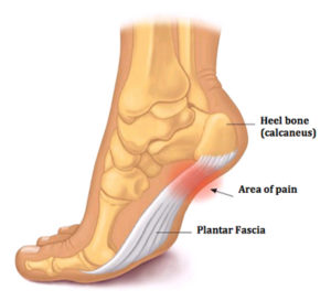 Read more about the article Plantar Fasciitis