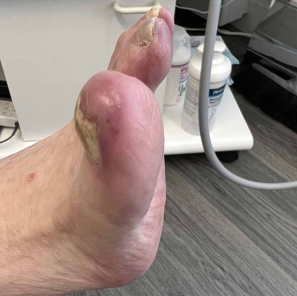 Foot People Lindsay Chiropody podiatry chilblains treatment