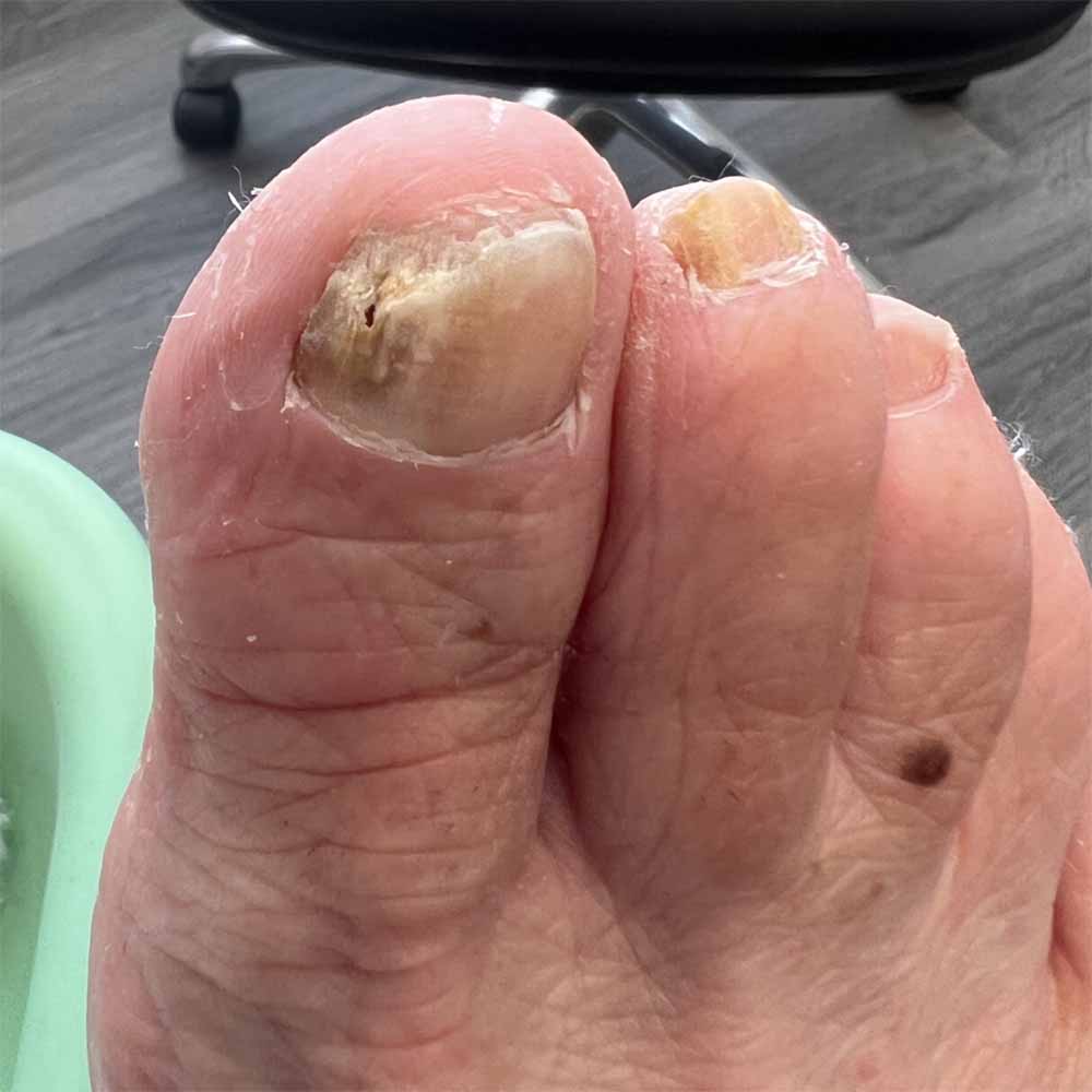 What is the best way to get rid of toenail fungus? - Quora