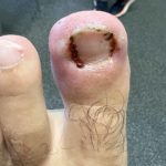 Foot People Lindsay Chiropody podiatry ingrowing toenail