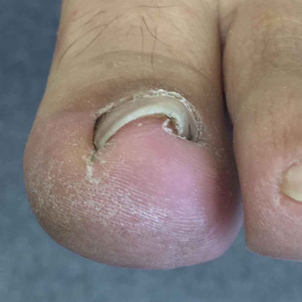 Involuted Toenails - The Foot People
