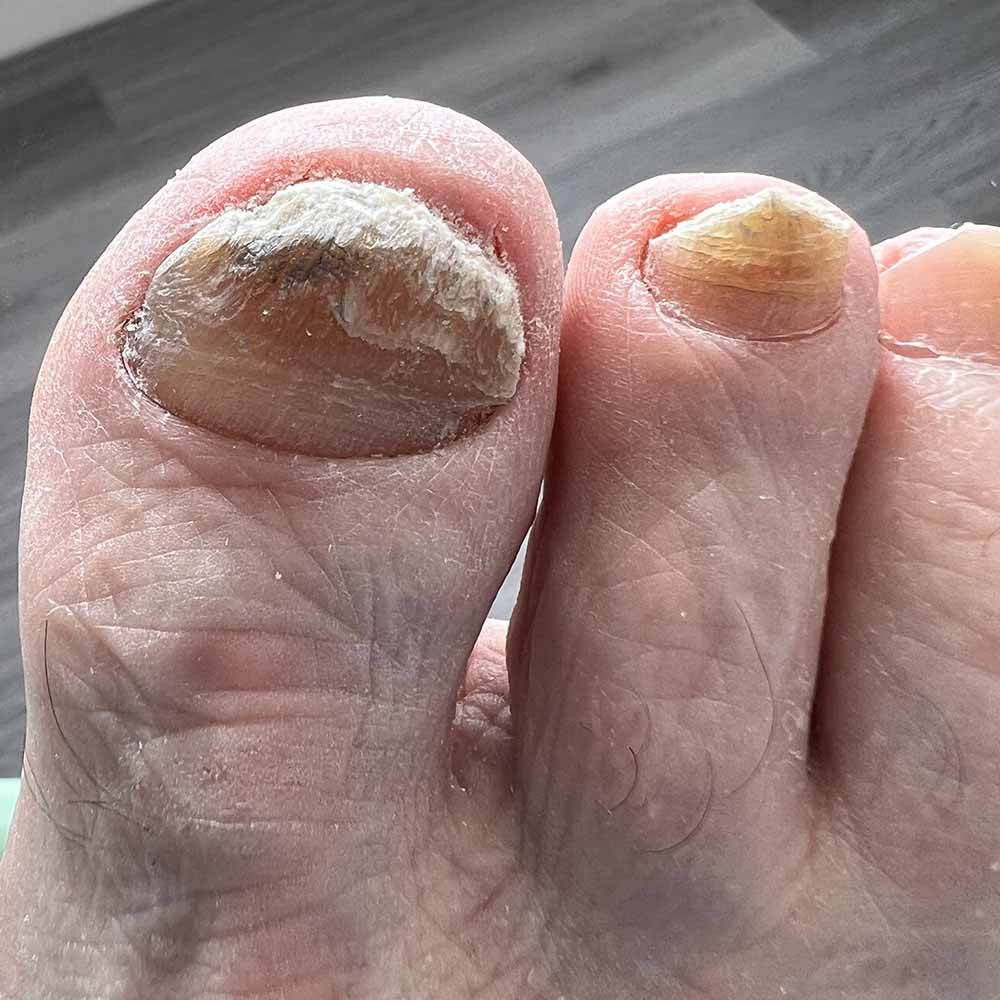 Thickened Toe Nails - Home Visit Foot Care